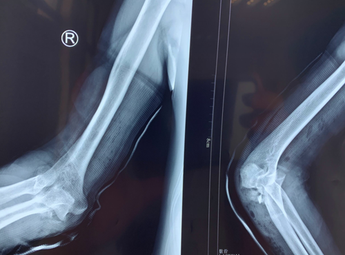 右腓骨骨折,右尺骨鹰嘴开放性粉碎性骨折,右肘关节脱位,右股骨大粗隆